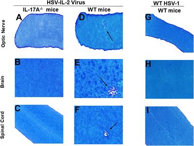 IL-17A expression by both T cells and non-T cells contribute to HSV-IL-2-induced CNS demyelination